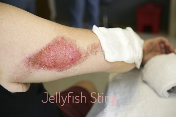 Jellyfish Sting