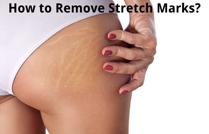How to Remove Stretch Marks?