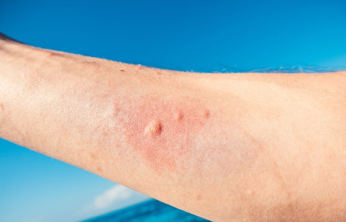 Symptoms of a Jellyfish Sting