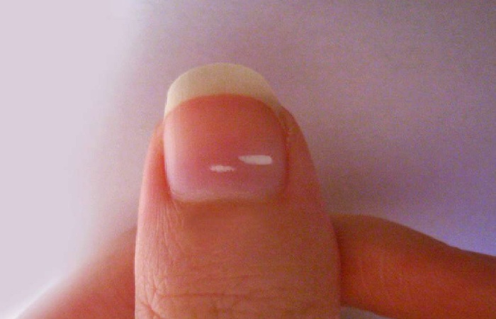 Why are White Spots on the Nails?