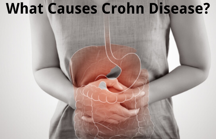 What Causes Crohn Disease?