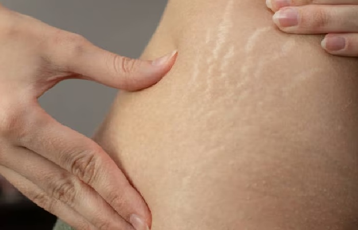 What Causes Stretch Marks?