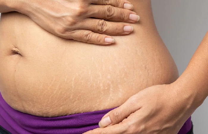 What are Stretch Marks?