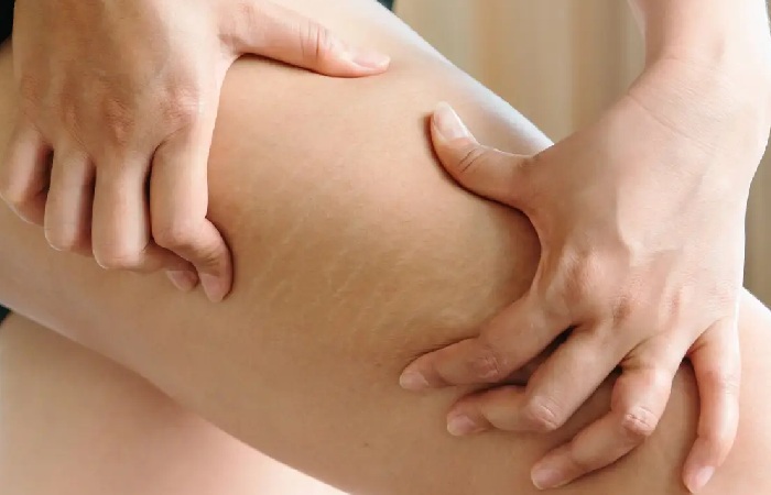 Risk Factors for Developing Remove Stretch Marks