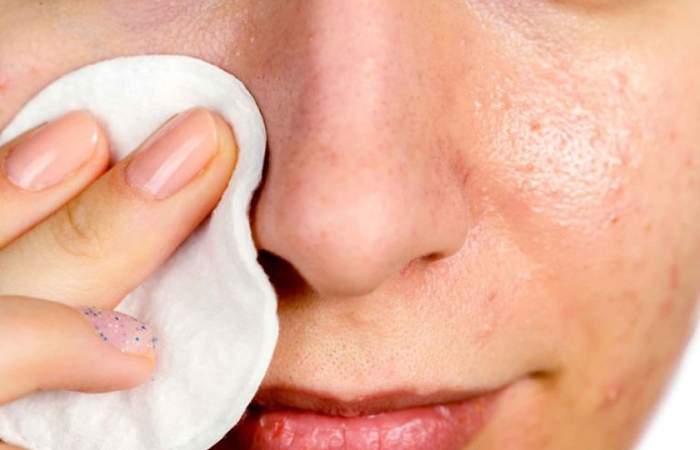 What Causes Blackheads?