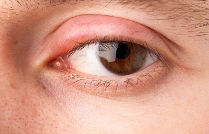 How to Get Rid of Swollen Eyelids_