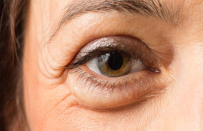 The Causes of Swollen Eyes